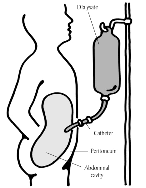 Diagram of patient performing peritoneal dialysis.