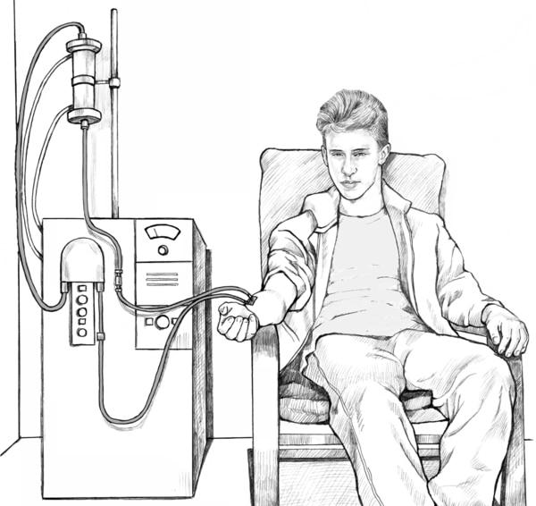Drawing of a teenage boy on hemodialysis. One set of tubes takes the patient's blood to the dialyzer. Another set of tubes returns the blood to the patient's body.