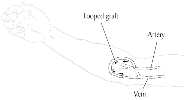 Drawing of an arm with an arteriovenous graft. Labels point to an artery and a vein. A curved tube, labeled looped graft, connects the artery to the vein. Arrows show the direction of blood flow from the artery to the vein.