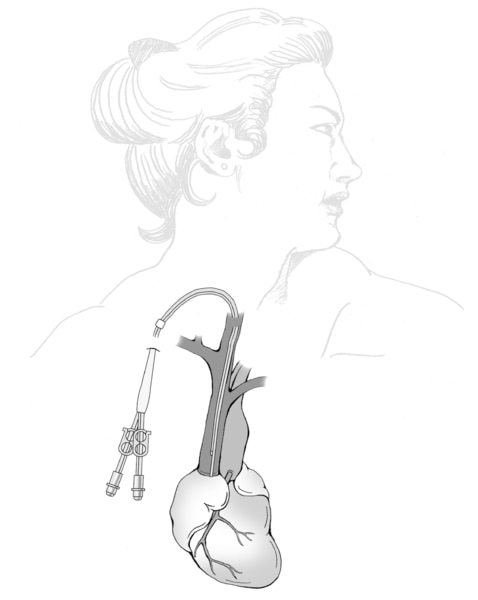 Drawing of a venous catheter for temporary hemodialysis access. The catheter is inserted through the skin near the collar bone. The catheter is connected to the  large vein from the heart. The other end of the catheter branches into two portals.