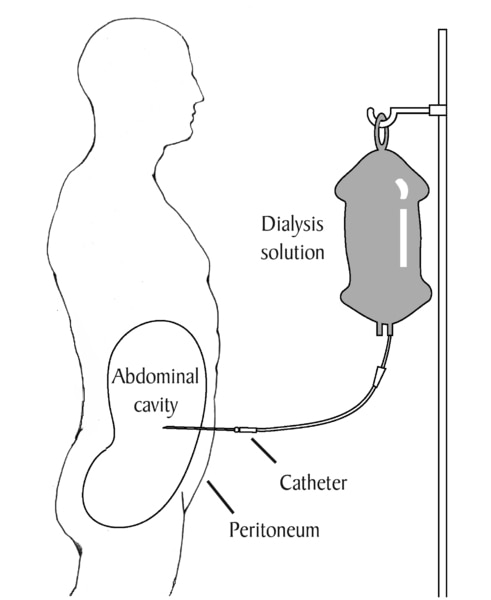 Diagram of a patient receiving peritoneal dialysis. Labels point to dialysis solution, catheter, peritoneum, and abdominal cavity. Dialysis solution in a plastic bag drips through the catheter into the abdominal cavity.