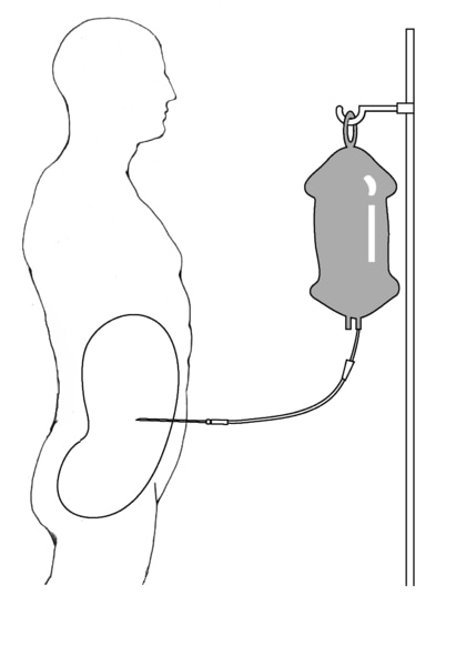 Diagram of a patient receiving peritoneal dialysis. Dialysis solution in a plastic bag drips through the catheter into the abdominal cavity.