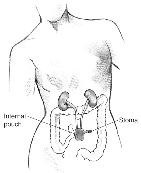 Drawing of a continent cutaneous reservoir. Labels point to the internal pouch and stoma.