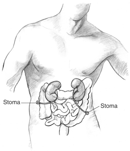 Drawing of a ureterostomy. Two stomas are labeled.