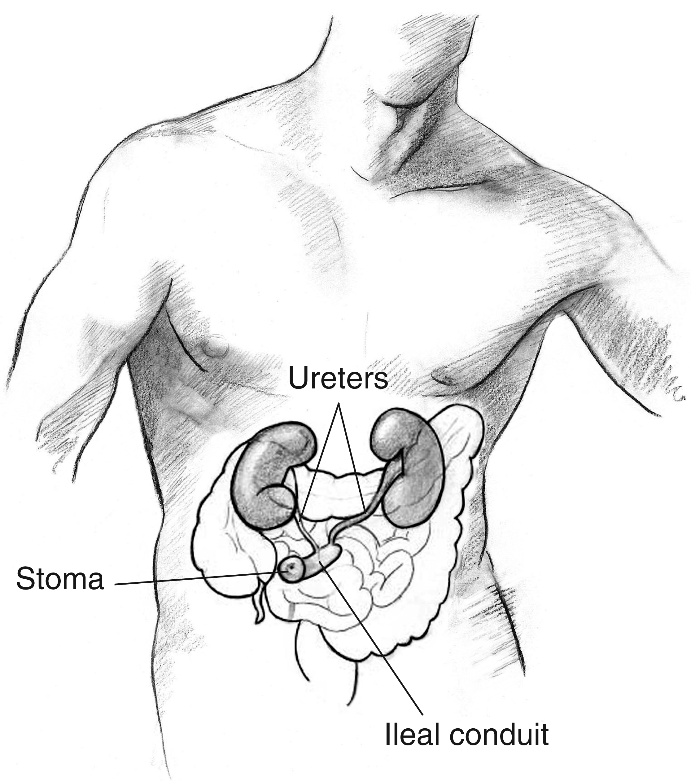 An ileal conduit urostomy. Labels point to the stoma, ileal conduit