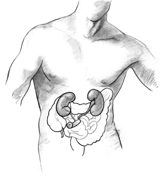 Drawing of an ileal conduit urostomy.