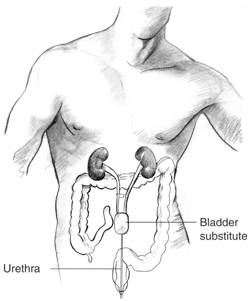 Drawing of a bladder substitute.