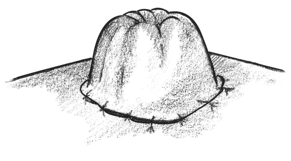 Drawing of a stoma.