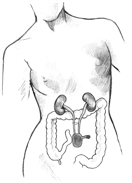 Drawing of a continent cutaneous reservoir.