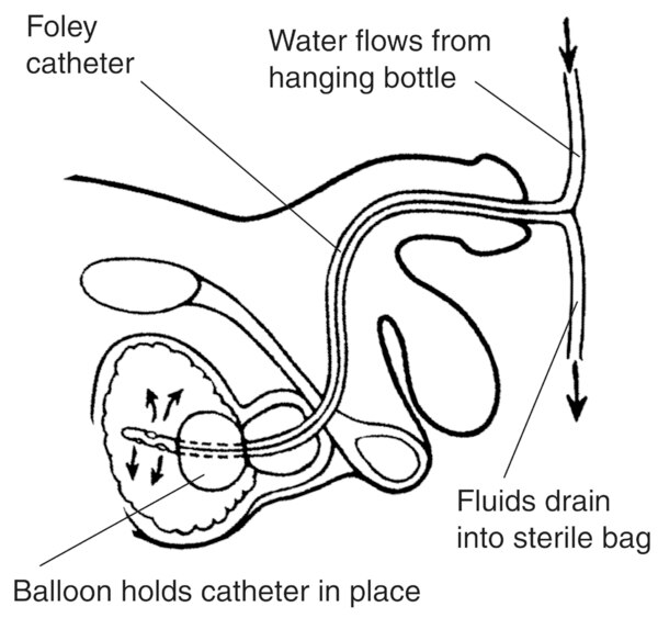 Side-view diagram of male urinary tract with Foley catheter in place to drain urine. A label points to the Foley catheter, which consists of two tubes for fluids flowing in and out of the bladder. A label explains that a balloon near the tip of the cathet