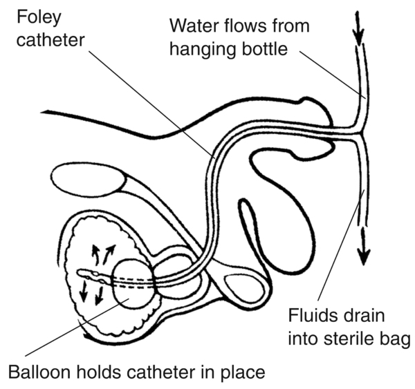 Side-view diagram of male urinary tract with Foley catheter in place to drain urine. A label points to the Foley catheter, which consists of two tubes for fluids flowing in and out of the bladder. A label explains that a balloon near the tip of the cathet