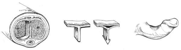 Drawing of a cross section of the penis showing the internal cavity that runs the length of the penis and is divided into two chambers (corpora cavernosa) by a vertical connecting tissue known as a septum. Drawing of a septum attached to the lining.