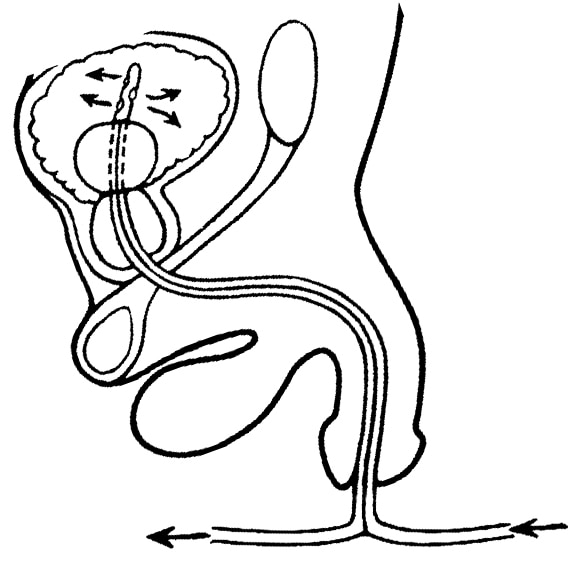 Side-view diagram of male urinary tract with Foley catheter in place to drain urine. The Foley catheter consists of two tubes for fluids flowing in and out of the bladder. A balloon near the tip of the catheter holds the catheter in place in the bladder.