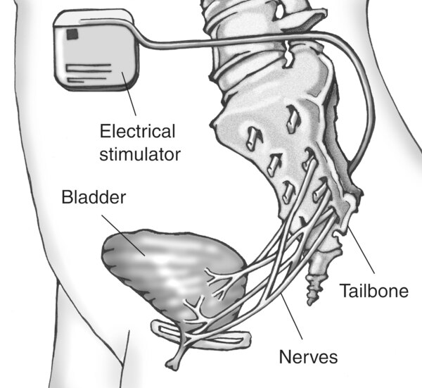 Drawing of an electrical stimulator for bladder nerves, an implanted device that delivers mild electrical pulses to the nerves that control bladder function.