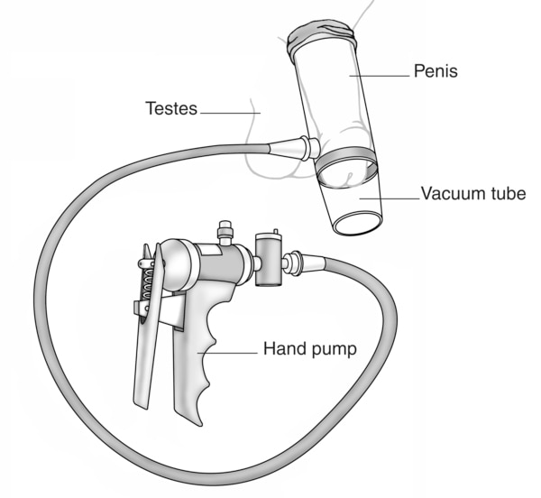 Drawing of a vacuum tube for making an erection.