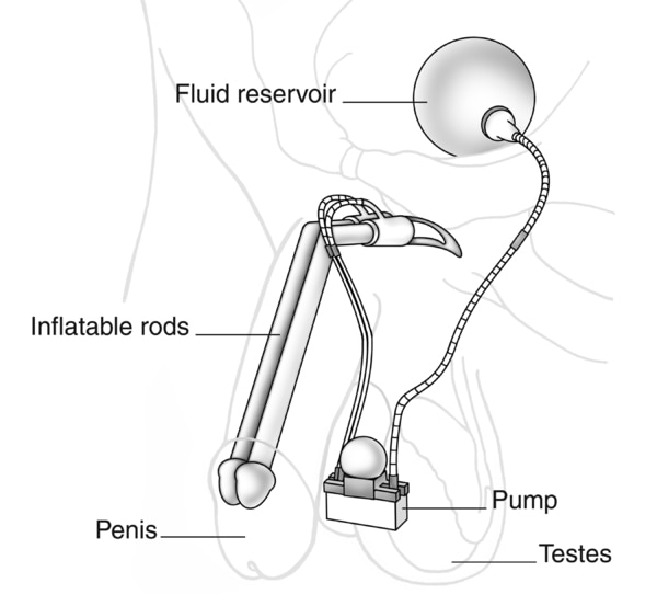 Drawing of a penile implant.