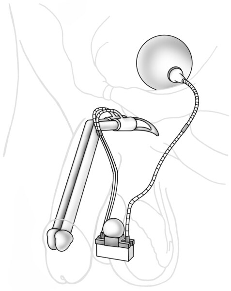 Drawing of a penile implant.