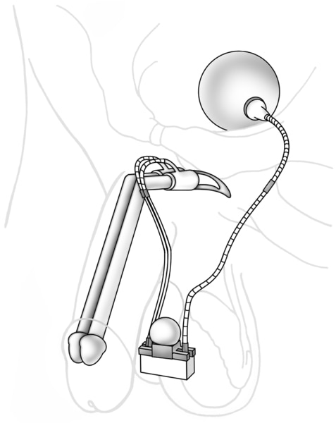 Drawing of a penile implant.