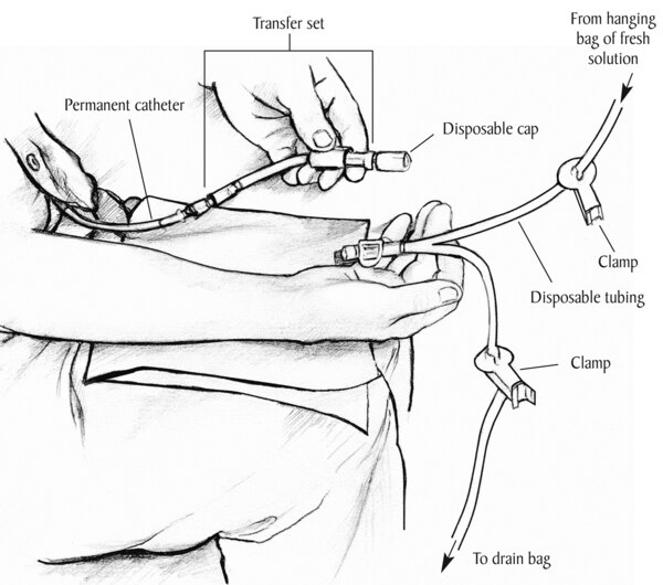 Drawing of transfer set, catheter, and disposable tubing, labeled.