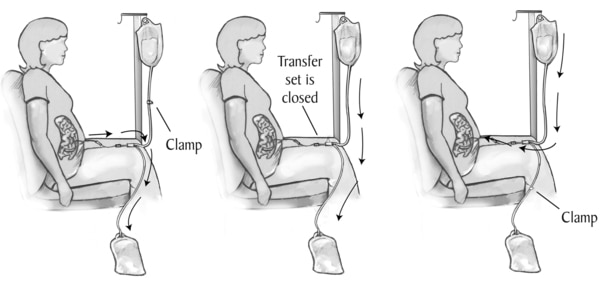 Drawing of three steps in peritoneal dialysis exchange, labeled.