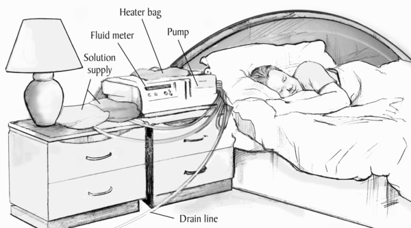 Drawing of a peritoneal dialysis cycler.