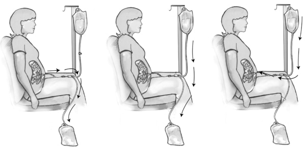 Diagram of three steps in peritoneal dialysis exchange.