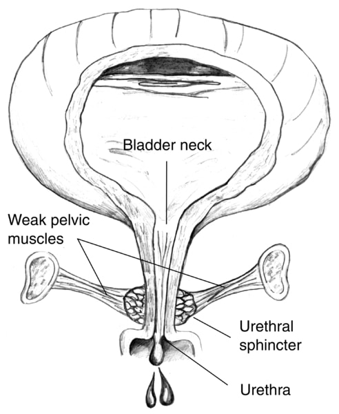 Diagram of front view of female bladder with weak pelvic muscles. The bladder is shown in cross-section to reveal urine in the bladder. The weak pelvic muscles fail to keep the urethra closed, so urine escapes.  Labels point to the bladder neck, weak pelv