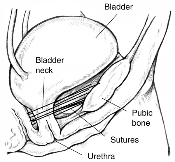 Diagram of Burch suspension for urinary incontinence. The side-view drawing shows the bladder supported by a web of sutures attached to the pubic bone. Labels point to the bladder, bladder neck, pubic bone, sutures, and urethra.
