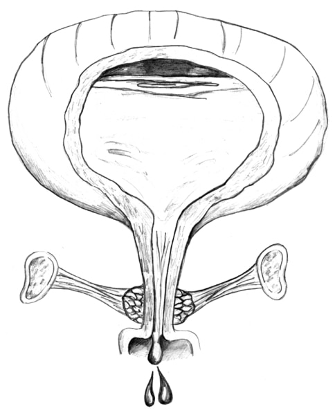 Diagram of front view of female bladder with weak pelvic muscles. The bladder is shown in cross-section to reveal urine in the bladder. The weak pelvic muscles fail to keep the urethra closed, so urine escapes.