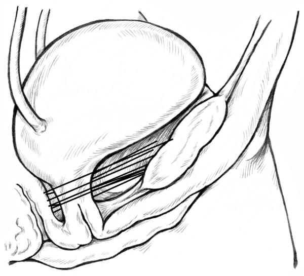 Diagram of Burch suspension for urinary incontinence. The side-view drawing shows the bladder supported by a web of sutures attached to the pubic bone.