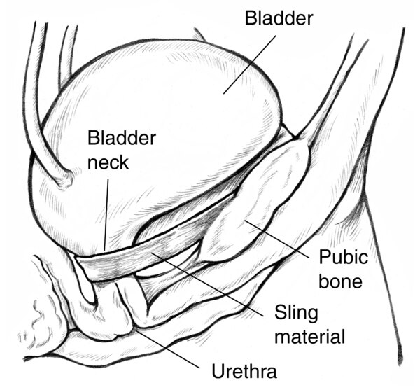 Diagram of side view of female bladder supported by a sling to prevent urinary incontinence. The sling is wrapped around the urethra, and the ends are attached to the pubic bone. Labels point to the bladder, bladder neck, pubic bone, sling material, and u
