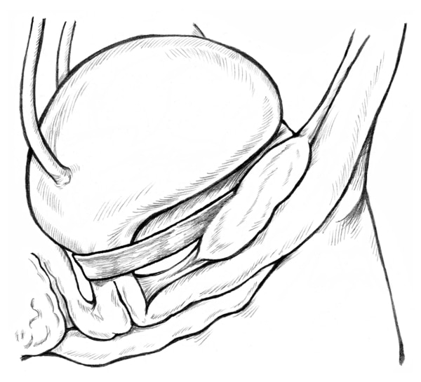 Diagram of side view of female bladder supported by a sling to prevent urinary incontinence. The sling is wrapped around the urethra, and the ends are attached to the pubic bone.