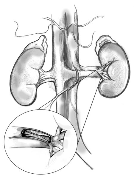Drawing of the kidneys with an insert showing a magnified cross-section of the renal artery with plaque building up on the inner wall.