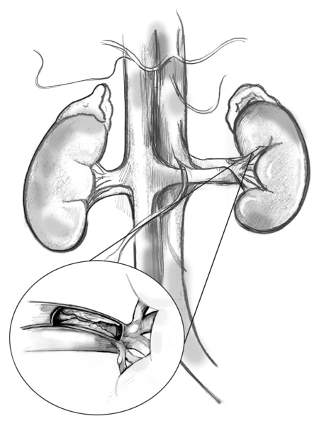 Drawing of the kidneys with an insert showing a magnified cross-section of the renal artery with plaque building up on the inner wall.