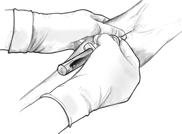 Drawing of health professional's gloved hands inserting hypodermic needle into patient's vein to draw blood.