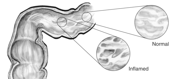 Drawing of the lining of the GI tract. An inset image shows normal tissue and another inset image shows inflamed tissue.