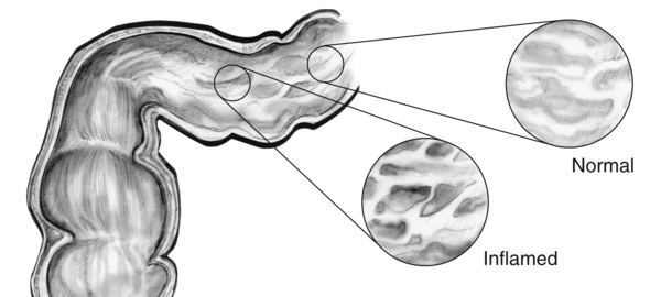 Drawing of the lining of the GI tract. An inset image shows normal tissue and another inset image shows inflamed tissue.