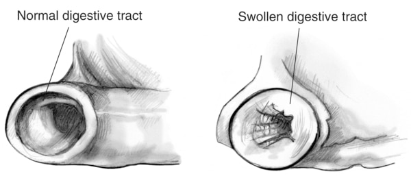 Drawing of two cross-sections of the digestive tract. One cross-section shows a normal digestive tract. The other cross-section shows a swollen digestive tract. The swollen digestive tract has a narrow passage.