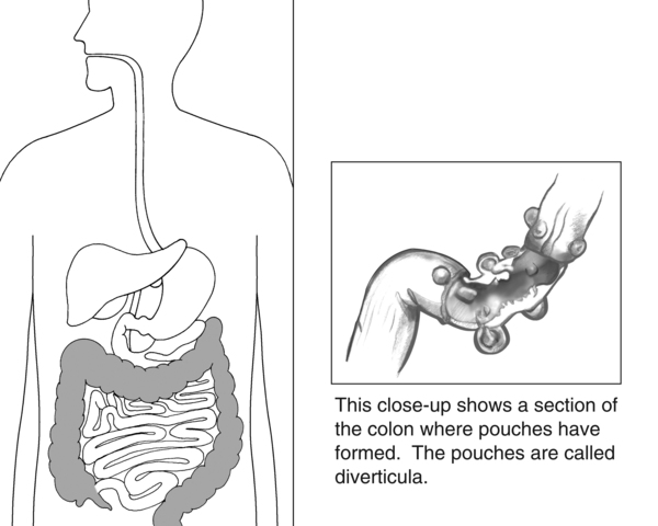 Drawing of digestive tract with the colon highlighted. Next to it is a close-up section of the colon with diverticula, or pouches.