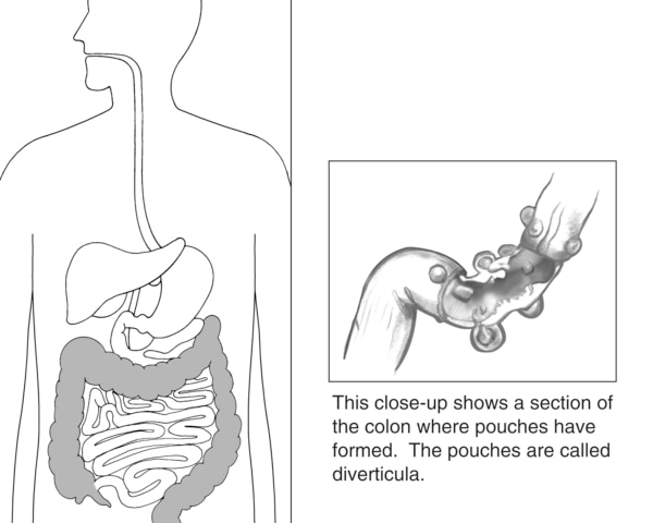 Drawing of digestive tract with the colon highlighted. Next to it is a close-up section of the colon with diverticula, or pouches.