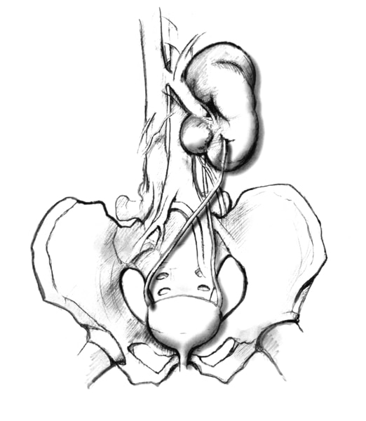Anatomic drawing of bladder, ureters, and fused kidneys. The kidney that would normally be on the left side of the picture has crossed over and fused with the kidney on the right.