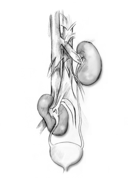 Anatomic drawing of bladder, ureters, and kidneys. The kidney on the right of the picture is in the normal position, several inches above the bladder. The kidney on the left is an ectopic kidney, just a couple of inches from the bladder.
