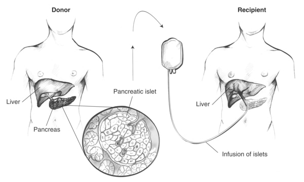 Drawing of two body torsos showing the infusion of islets extracted from a donor pancreas into a transplant recipient.
