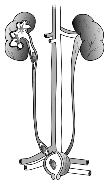 Drawing of the urinary tract with cross-sections to show stones in the kidney, ureter, and bladder.