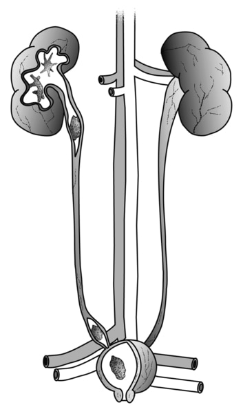 Drawing of the urinary tract with cross-sections to show stones in the kidney, ureter, and bladder.