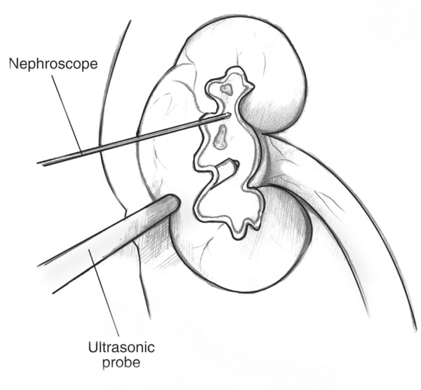 Drawing of a kidney cross section with a kidney stone. A wire called a nephroscope is inserted through the skin into the kidney to locate the stone. A thicker probe labeled ultrasonic probe is inserted through the skin into the kidney to deliver sound wav