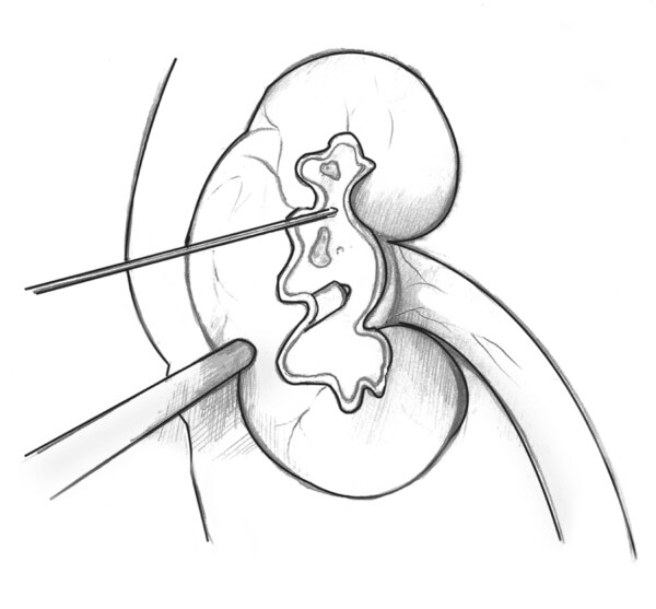Drawing of a kidney in cross-section to show an internal stone. A thin wire is inserted through the skin into the kidney to locate the stone. A slightly thicker probe is also inserted through the skin into the kidney to deliver sound waves that will break