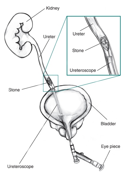 Drawing of the bladder, ureter, and kidney with a cross section of a ureteroscope inserted through the bladder into the ureter, where a stone blocks urine flow. Labels point to the kidney, ureter, stone, bladder, ureteroscope, and eyepiece. Inset is a cro