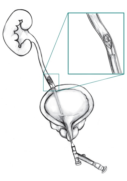Drawing of the bladder, ureter, and kidney with a cross section of a ureteroscope inserted through the bladder into the ureter, where a stone blocks urine flow. Inset is a cross section of the ureter that shows a wire basket at the end of the ureteroscope