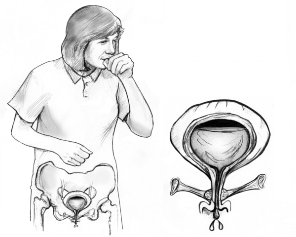 Drawing of woman coughing with pelvic bone and bladder revealed. An inset shows an enlarged view of the bladder with weak pelvic floor muscles that allow urine to escape.